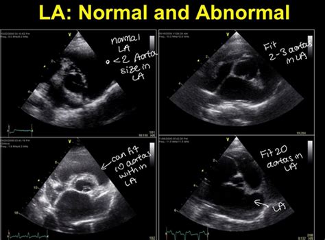 Understanding Normal VS Abnormal Echocardiogram Results.